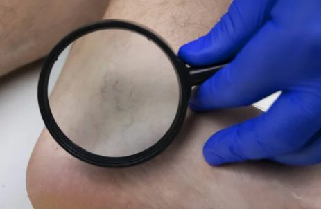 Veine regardée à la loupe par le chirurgien vasculaire